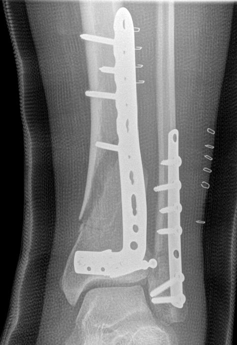 Distal tibia plate 5